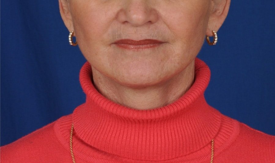 Case--8631 | After Facelift / Neck Lift
