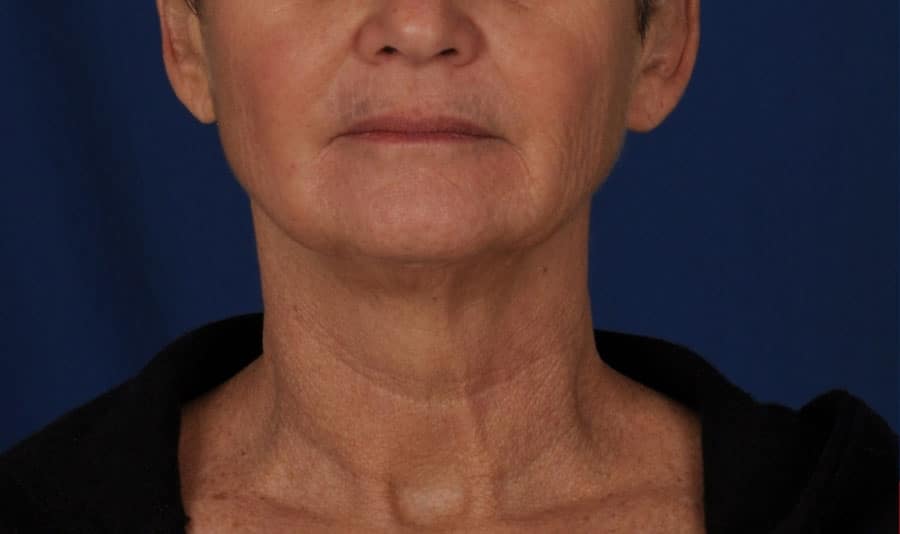 Case--8631 | Before Facelift / Neck Lift