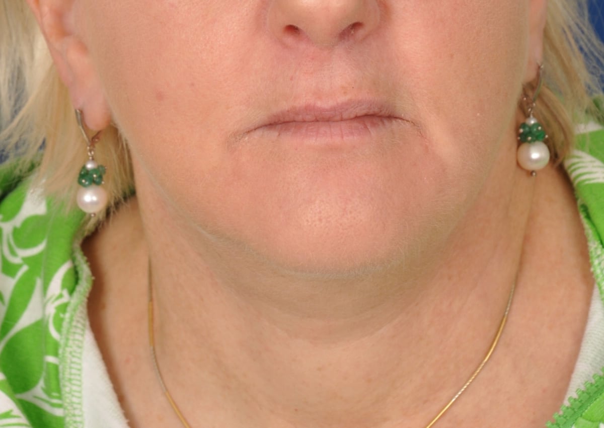 Case--9884 | After Facelift / Neck Lift