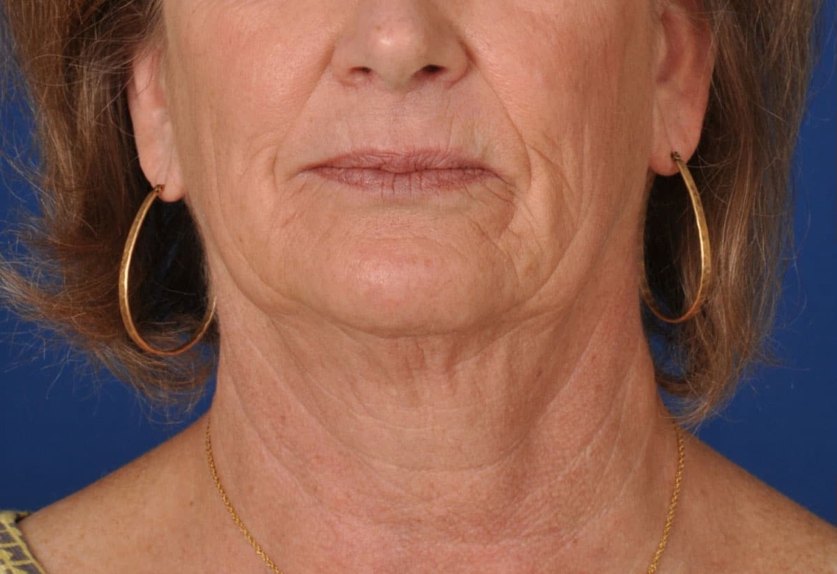 Case--2698 | Before Facelift / Neck Lift