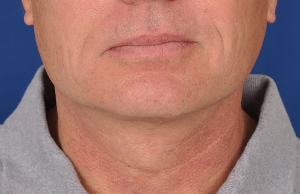 Case--3890 | After Facelift / Neck Lift