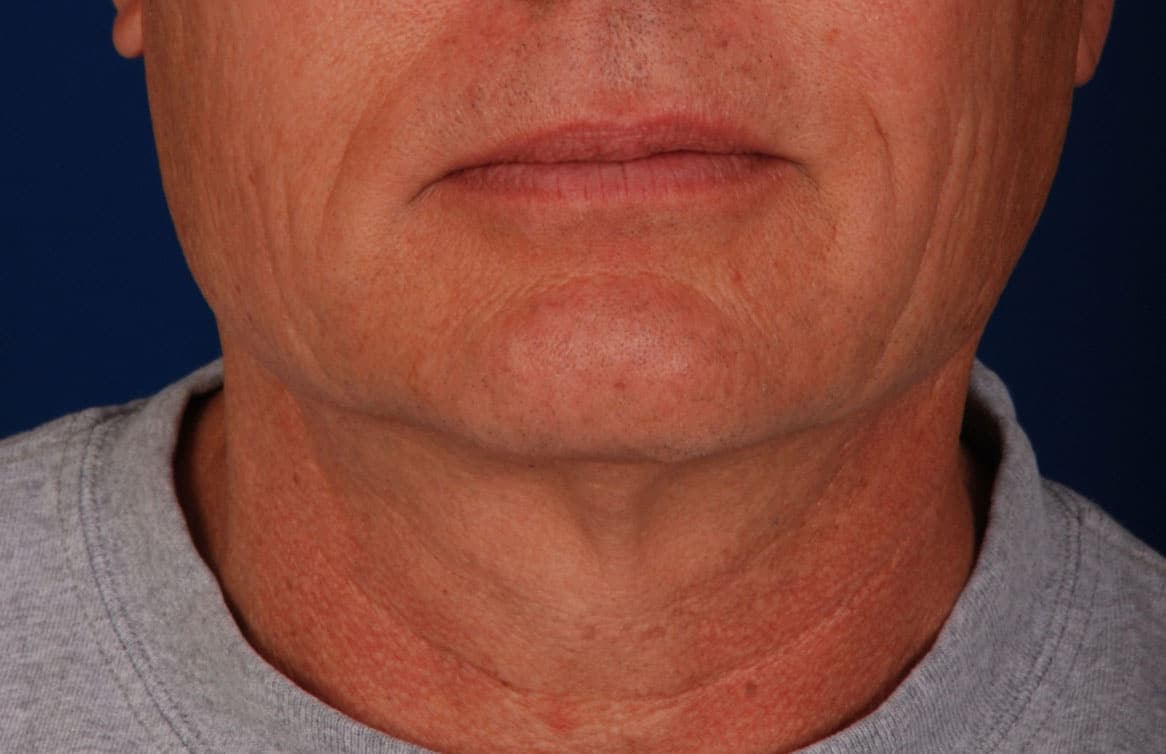 Case--3890 | Before Facelift / Neck Lift