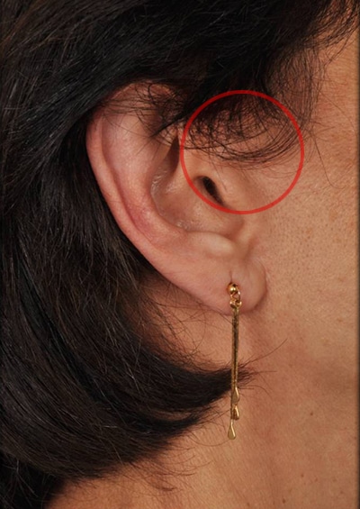 Case--4213 | After Incisions