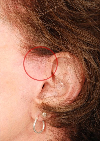 Case--5349 | After Incisions