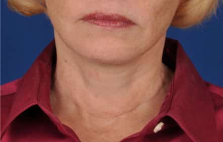 Case--6992 | After Facelift / Neck Lift