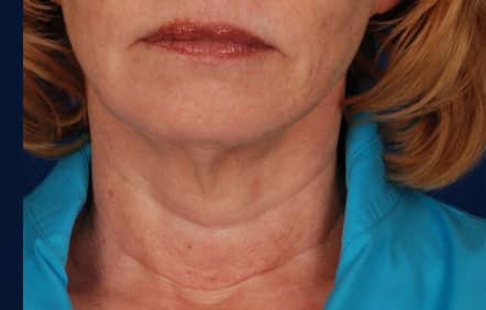 Case--6992 | Before Facelift / Neck Lift