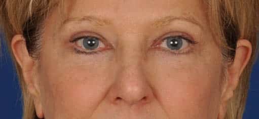 Case--9303 | After Blepharoplasty