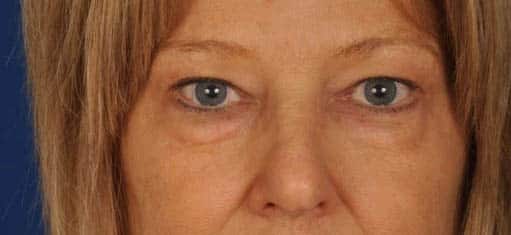 Case--9303 | Before Blepharoplasty